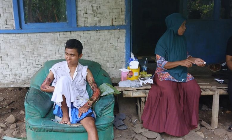 Kasihan Asep Kedua Tangannya Melepuh, Tiap Malam Menangis 1debb1f2 d415 4f18 9e00 f2571cf7578d