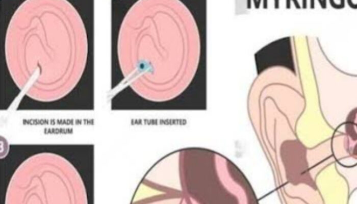 Panduan Lengkap Myringotomy: Prosedur, Manfaat, dan Pemulihan