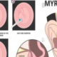 Panduan Lengkap Myringotomy: Prosedur, Manfaat, dan Pemulihan