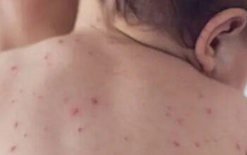 Bintik Merah di Badan, Kenali Perbedaannya Sejak Dini