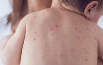 Campak pada Bayi: Fokus pada Penanganan Tepat, Bukan Mempercepat Keluarnya Ruam