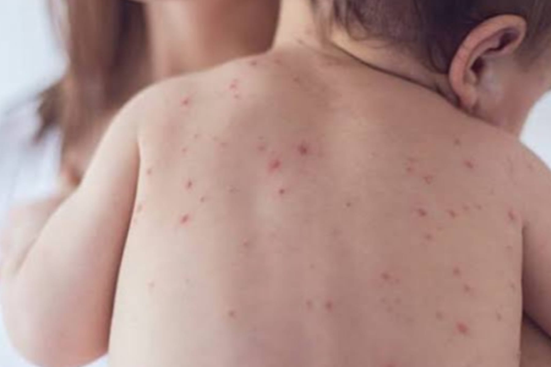 Campak pada Bayi: Fokus pada Penanganan Tepat, Bukan Mempercepat Keluarnya Ruam