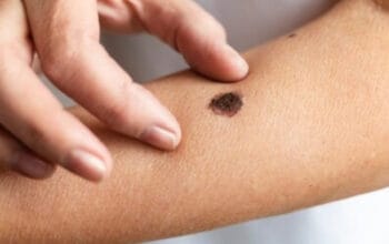 Mengenal Tahi Lalat Hidup: Ciri-ciri dan Kapan Harus Waspada