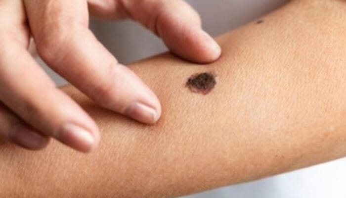 Mengenal Tahi Lalat Hidup: Ciri-ciri dan Kapan Harus Waspada