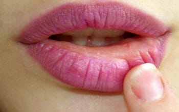 Cara Mengatasi Bibir Berdarah dan Pecah-Pecah