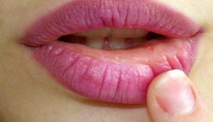 Cara Mengatasi Bibir Berdarah dan Pecah-Pecah