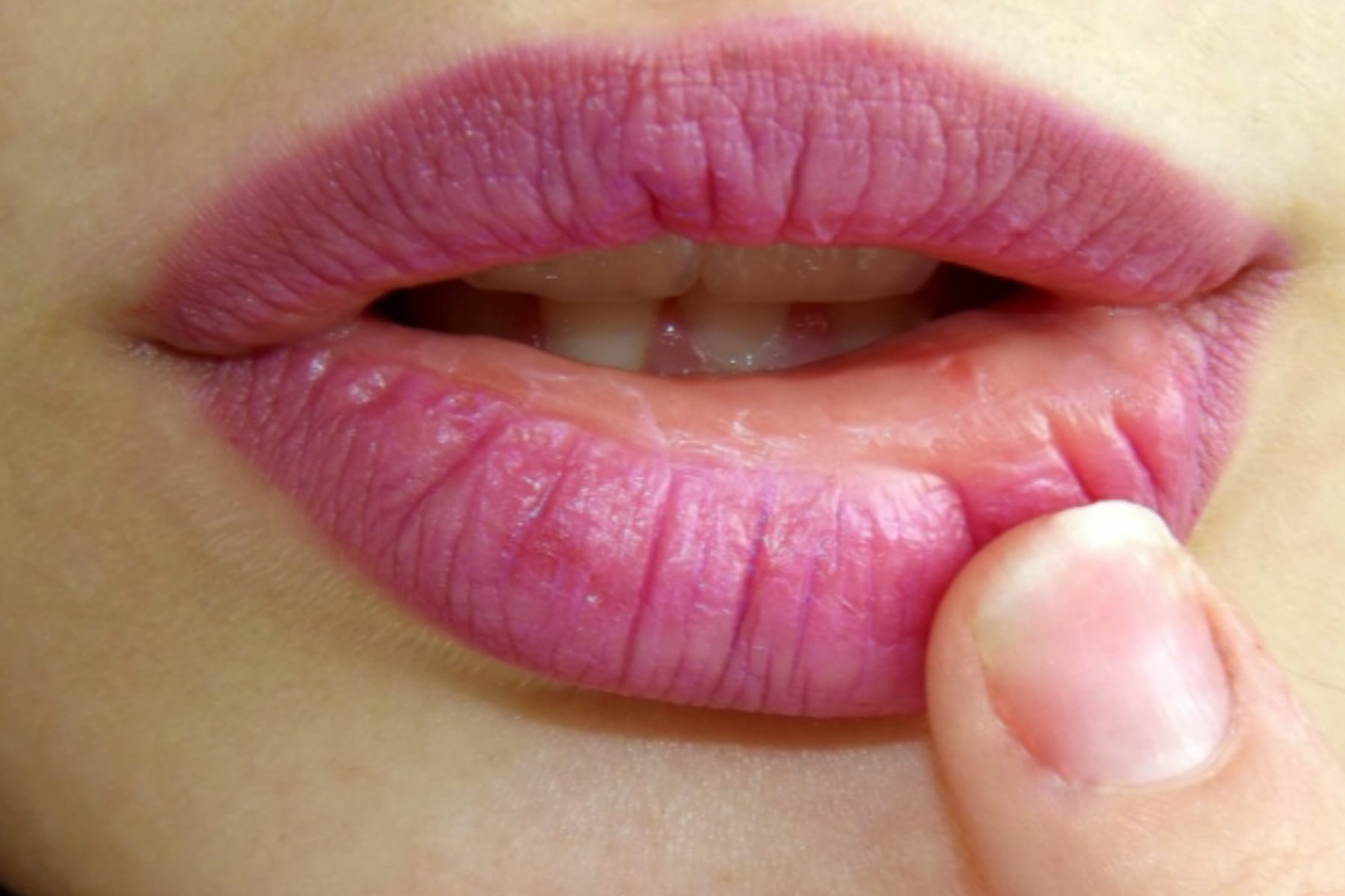 Cara Mengatasi Bibir Berdarah dan Pecah-Pecah 1 Cara Mengatasi Bibir Berdarah dan Pecah-Pecah