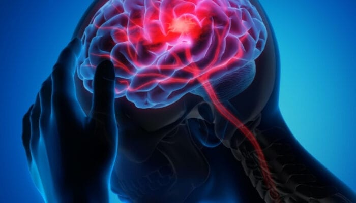 Panduan Mengatasi Migrain Sebelah Kanan yang Mengganggu