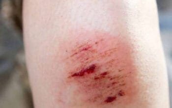 Panduan Praktis Cara Menghilangkan Perih pada Luka Lecet di Rumah