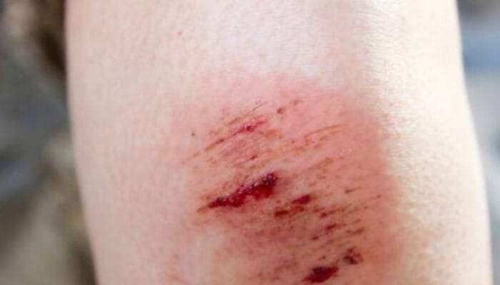 Panduan Praktis Cara Menghilangkan Perih pada Luka Lecet di Rumah