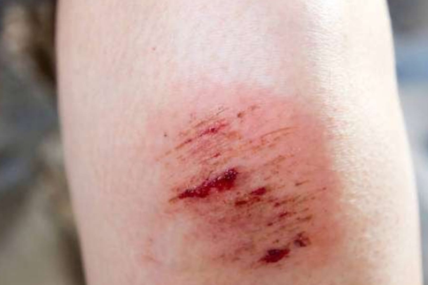 Panduan Praktis Cara Menghilangkan Perih pada Luka Lecet di Rumah