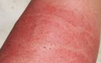 Penanganan Tepat Luka Bakar Menggelembung: Jangan Asal Pecah!