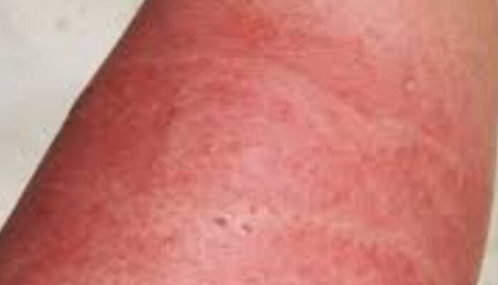 Penanganan Tepat Luka Bakar Menggelembung: Jangan Asal Pecah!