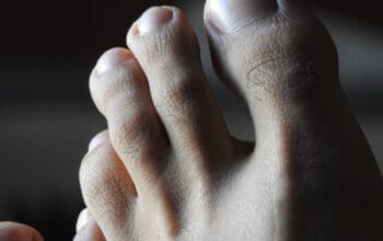 Waspada Kaki Diabetes: Kenali Tandanya Sebelum Terlambat 1 Waspada Kaki Diabetes: Kenali Tandanya Sebelum Terlambat