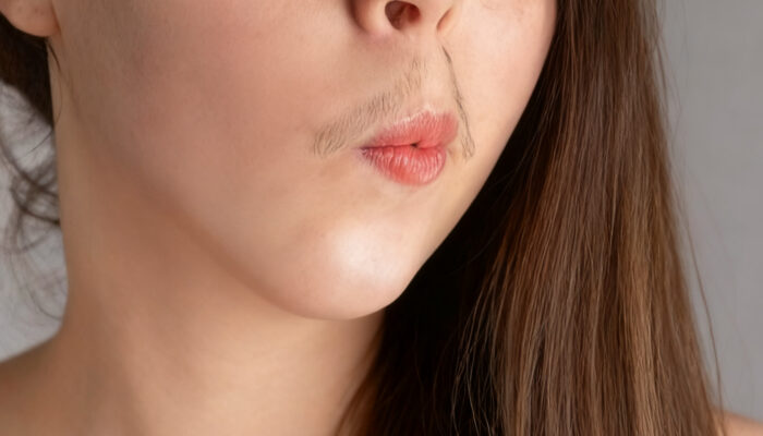 Cara Menghilangkan Kumis Tipis pada Wanita