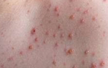 Cara Tepat Menangani Koreng Gatal Tanpa Bekas 1 Cara Tepat Menangani Koreng Gatal Tanpa Bekas