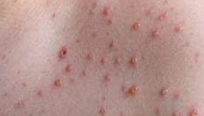 Cara Tepat Menangani Koreng Gatal Tanpa Bekas