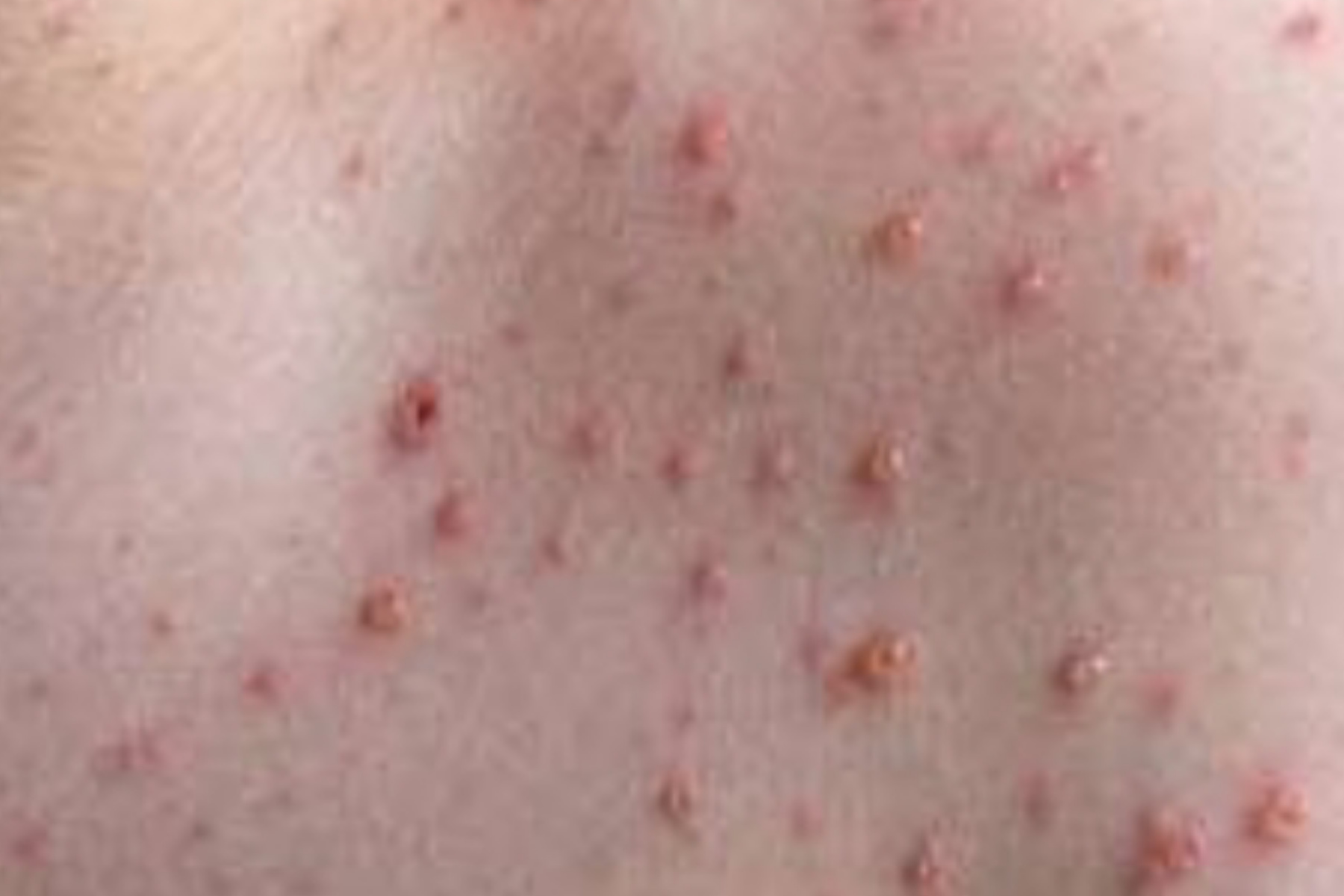 Cara Tepat Menangani Koreng Gatal Tanpa Bekas