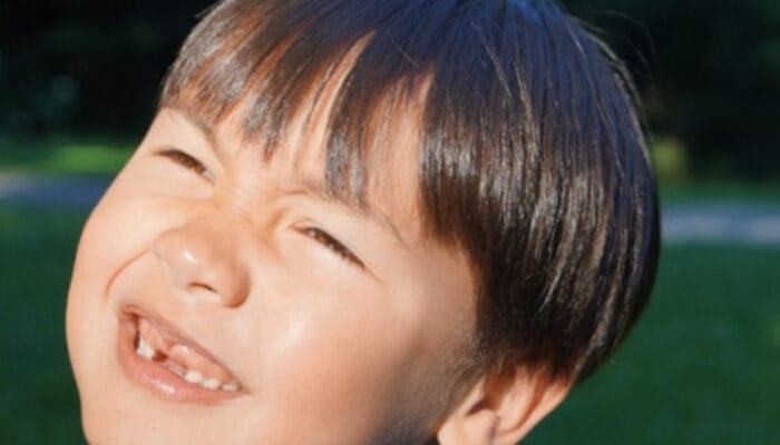 Dampak Gigi Ompong pada Anak yang Sering Disepelekan