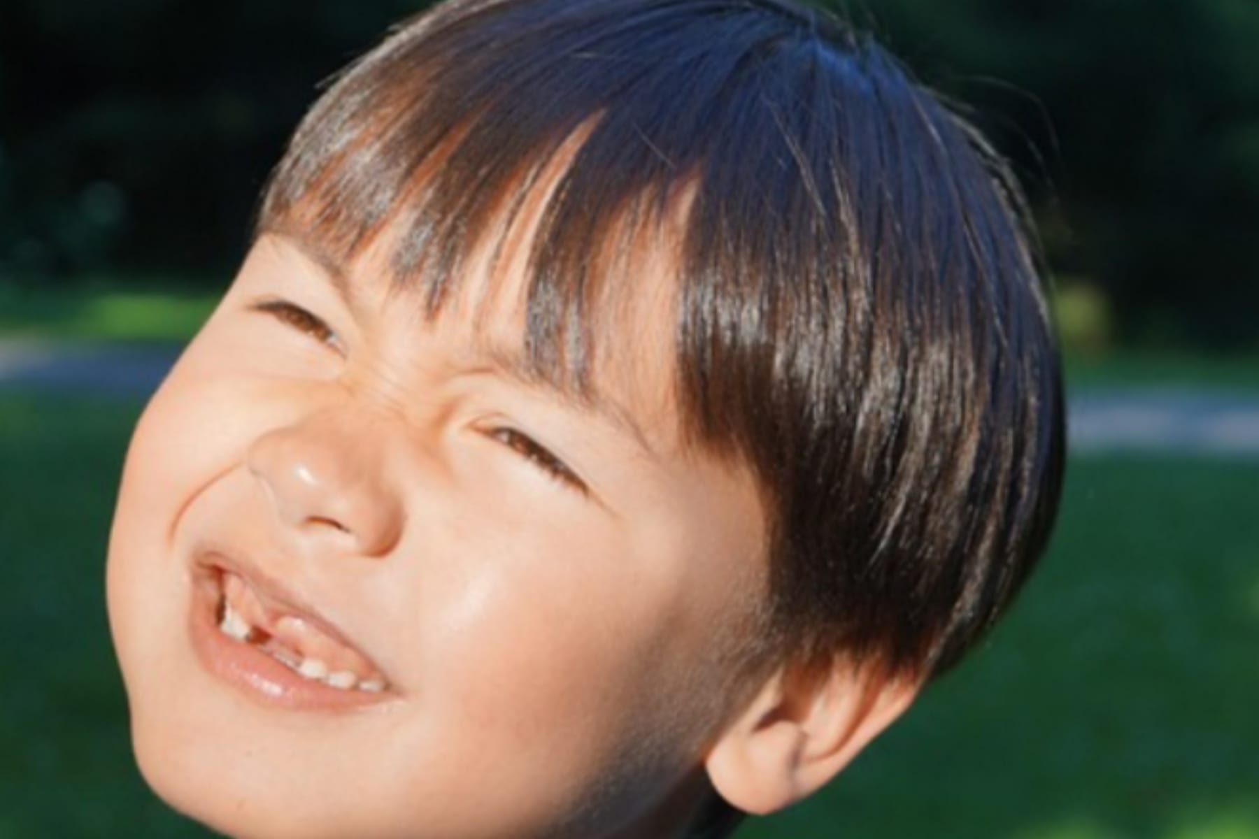 Dampak Gigi Ompong pada Anak yang Sering Disepelekan