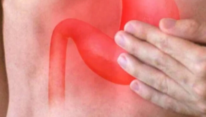 Apakah GERD Bisa Sembuh Total? Ini Faktanya