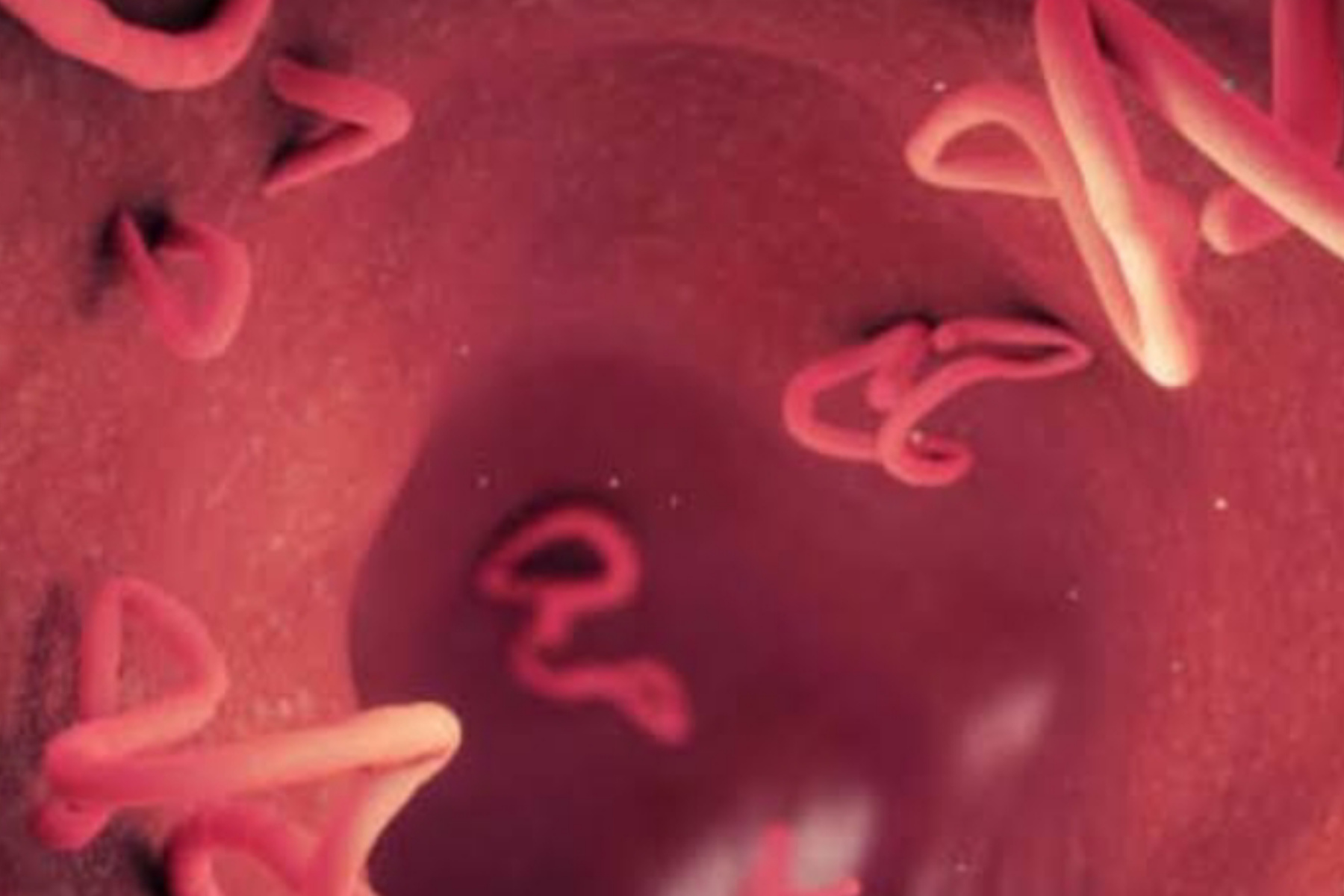 Bahaya Infeksi Cacing Mata yang Jarang Disadari