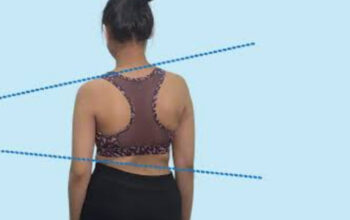 Brace Skoliosis: Solusi Cegah Operasi Tulang Belakang