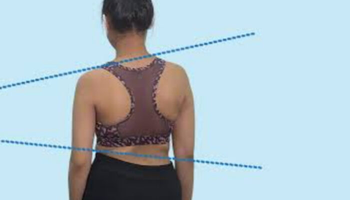 Brace Skoliosis: Solusi Cegah Operasi Tulang Belakang