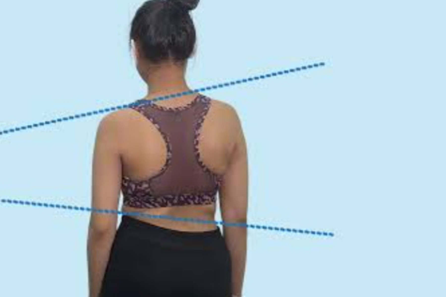 Brace Skoliosis: Solusi Cegah Operasi Tulang Belakang