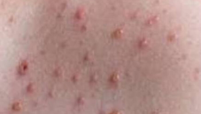 Cara Mengatasi Koreng dan Bekasnya pada Kulit