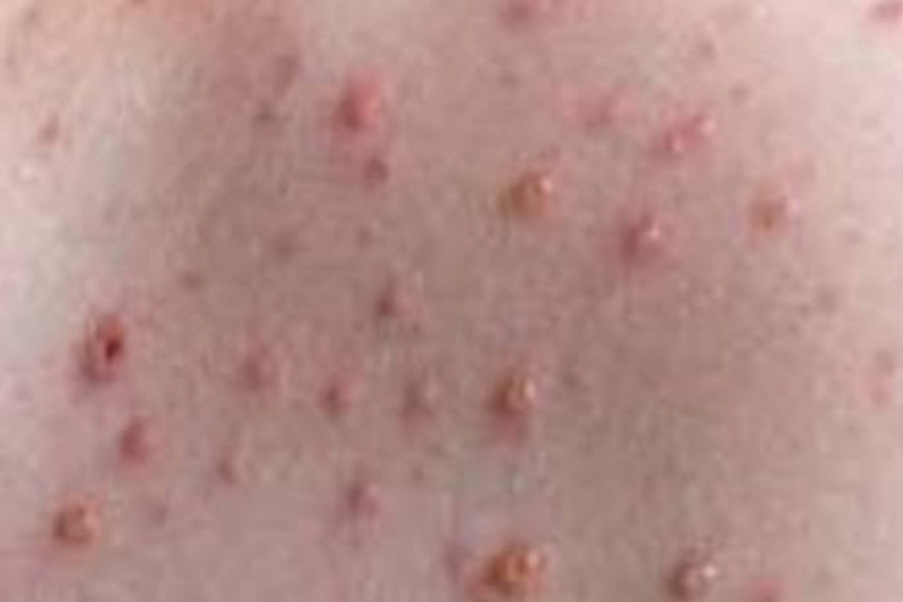 Cara Mengatasi Koreng dan Bekasnya pada Kulit