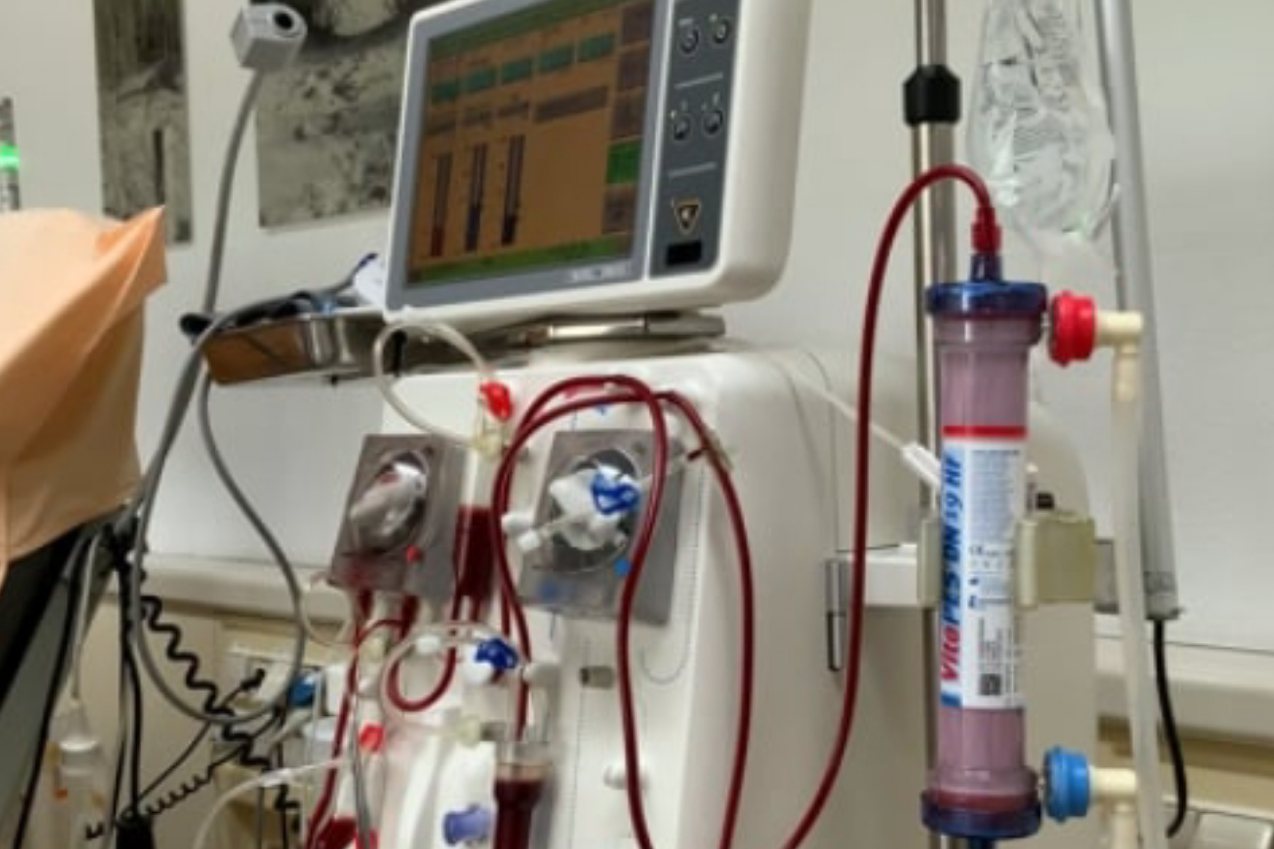 Harapan Baru Penderita Ginjal: Bisakah Berhenti Cuci Darah?