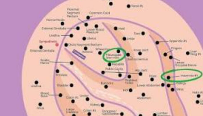 Mengenal Ear Seeds: Terapi Akupunktur Tanpa Jarum yang Viral