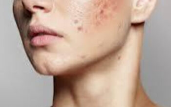 Solusi Kulit Berjerawat: Penyebab dan Cara Penanganan yang Tepat