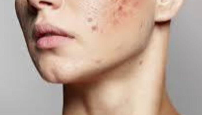 Solusi Kulit Berjerawat: Penyebab dan Cara Penanganan yang Tepat