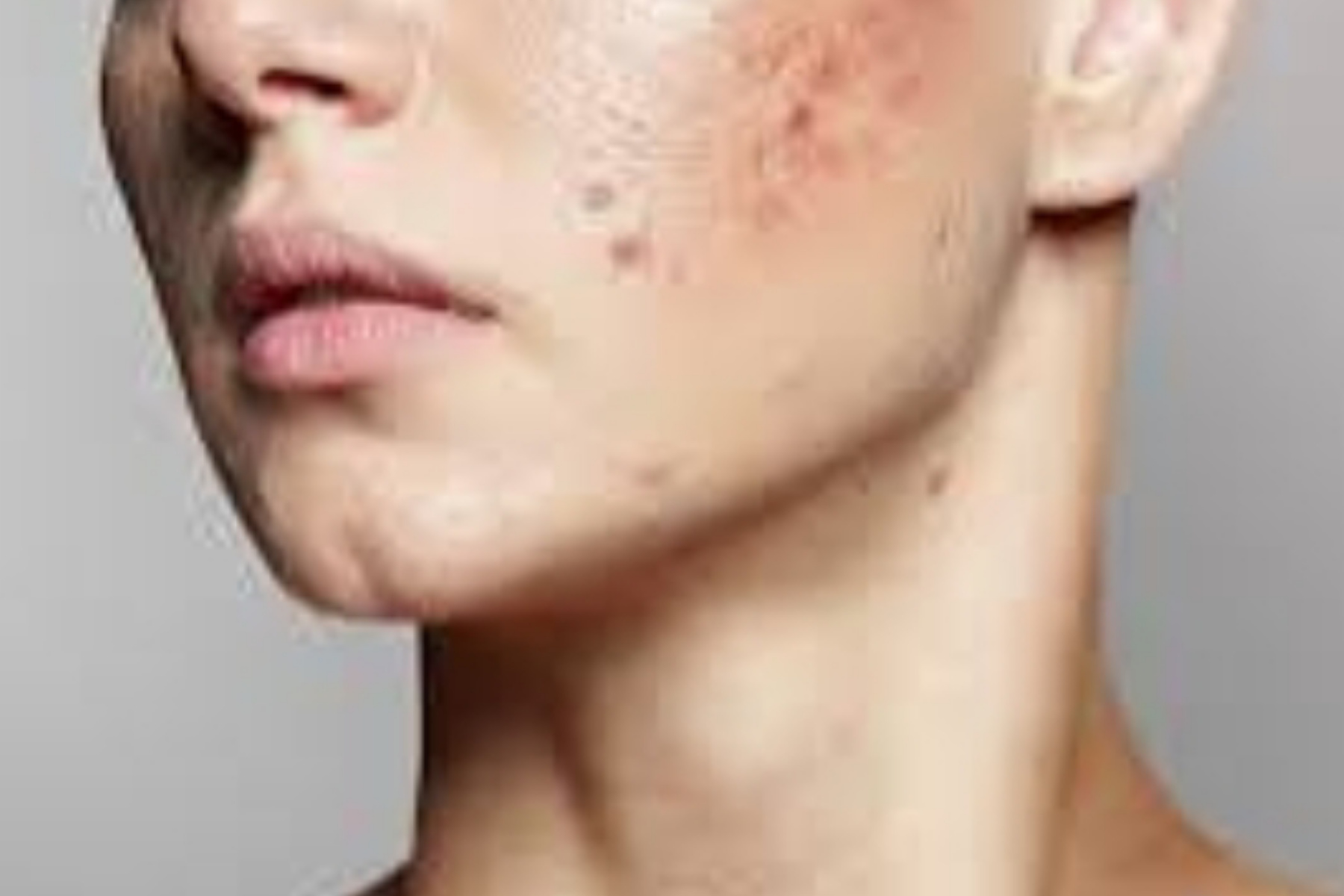 Solusi Kulit Berjerawat: Penyebab dan Cara Penanganan yang Tepat