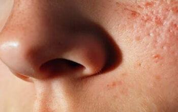 Mengatasi Hidung Merah: Penyebab dan Solusinya