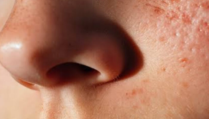 Mengatasi Hidung Merah: Penyebab dan Solusinya