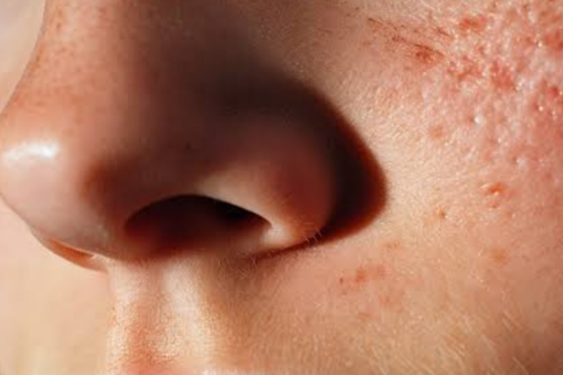 Mengatasi Hidung Merah: Penyebab dan Solusinya