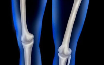 Mengenal Rekonstruksi ACL: Solusi Medis untuk Lutut Stabil Kembali