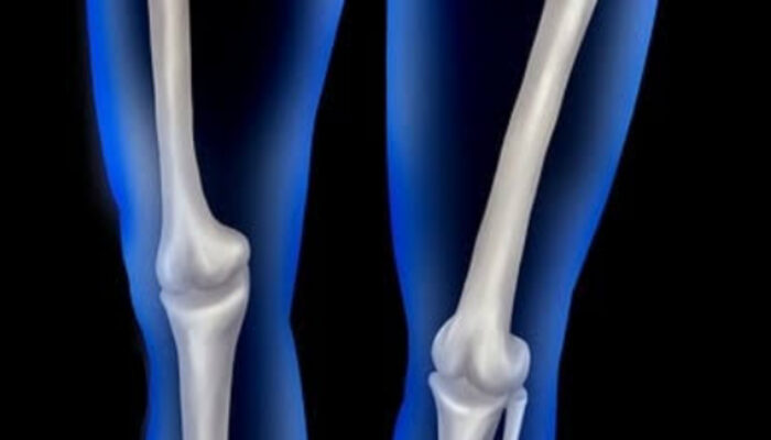 Mengenal Rekonstruksi ACL: Solusi Medis untuk Lutut Stabil Kembali