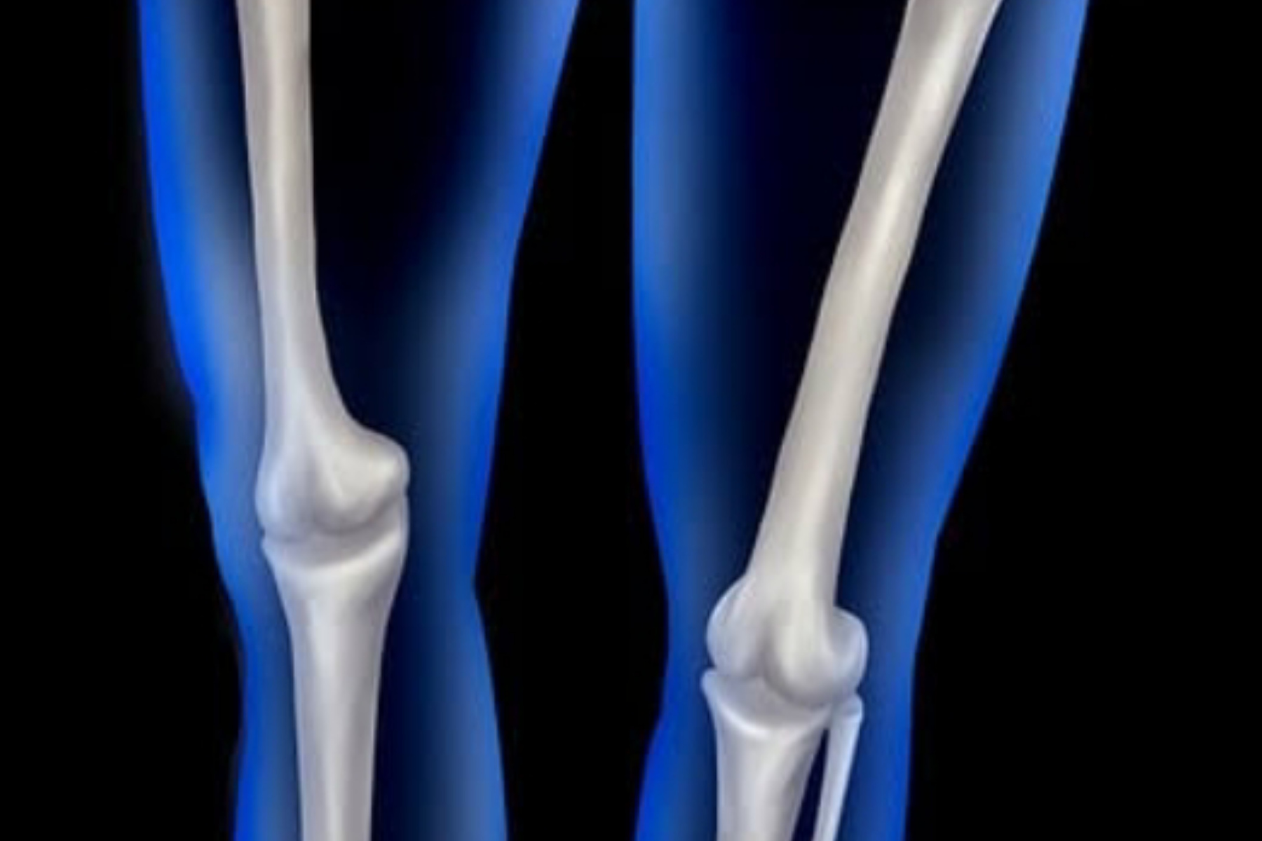 Mengenal Rekonstruksi ACL: Solusi Medis untuk Lutut Stabil Kembali