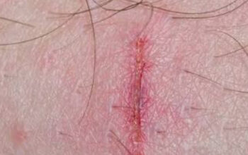 Panduan Praktis Cara Membersihkan Luka Bernanah dengan Benar