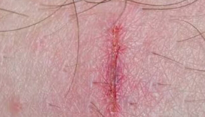 Panduan Praktis Cara Membersihkan Luka Bernanah dengan Benar