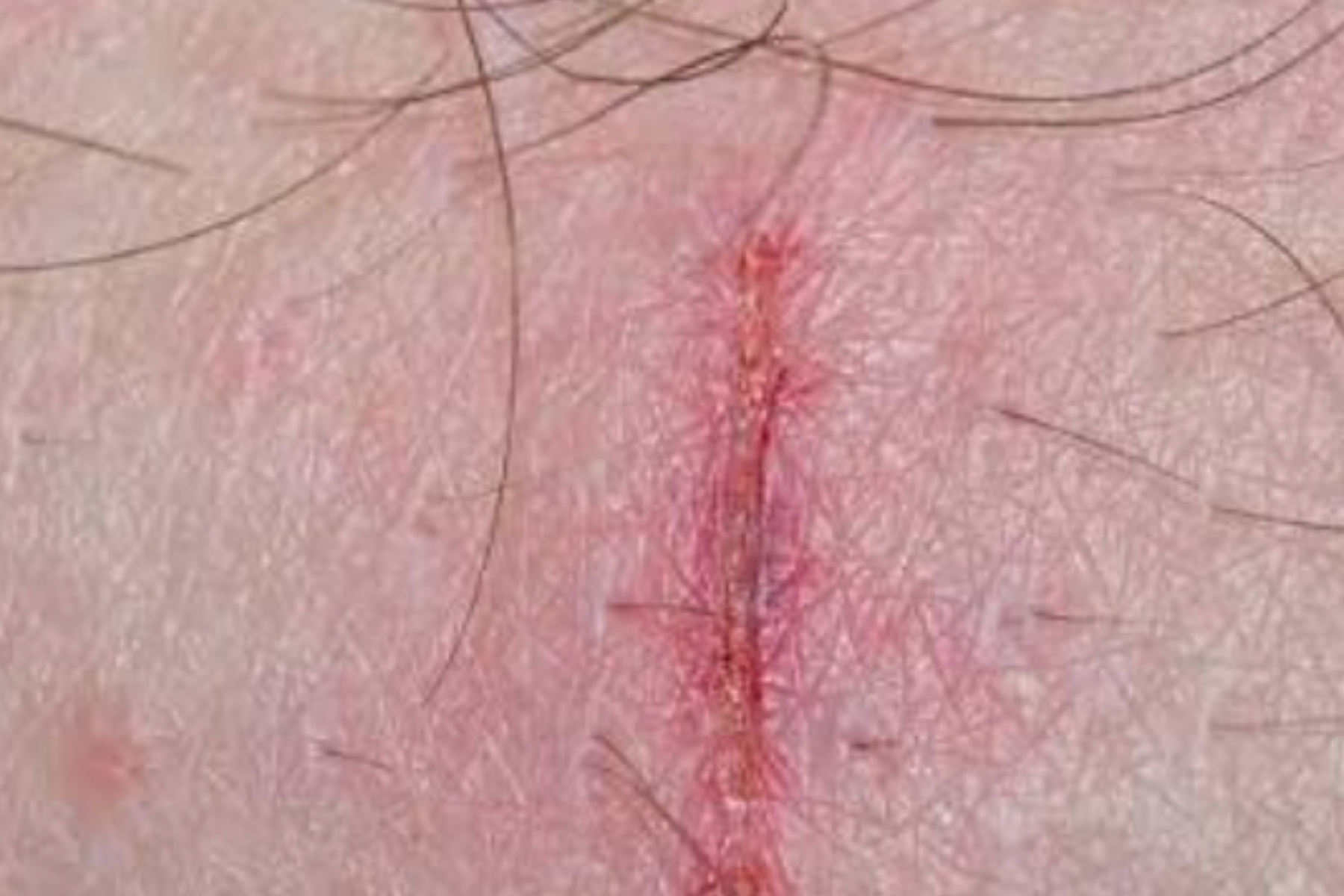 Panduan Praktis Cara Membersihkan Luka Bernanah dengan Benar