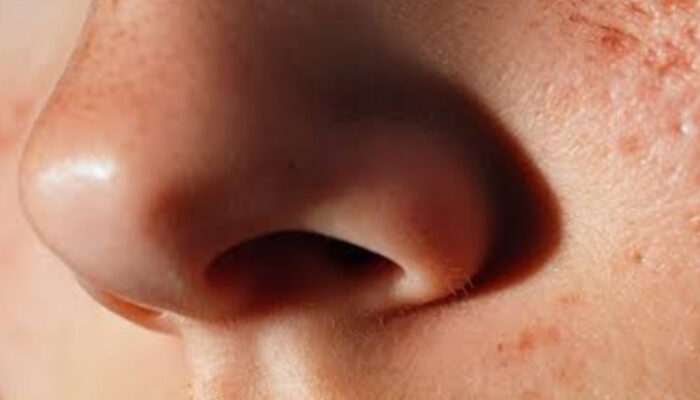 Pantangan Tanam Benang Hidung yang Wajib Anda Patuhi