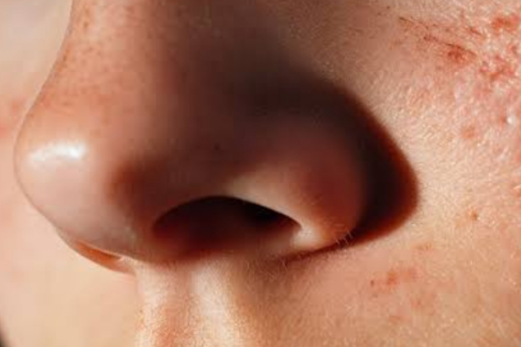 Pantangan Tanam Benang Hidung yang Wajib Anda Patuhi