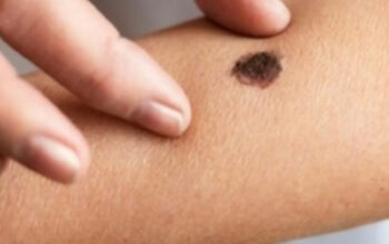 Rahasia Tahi Lalat Berambut: Kapan Anda Harus Waspada?