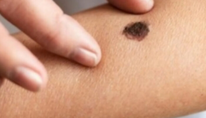 Rahasia Tahi Lalat Berambut: Kapan Anda Harus Waspada?