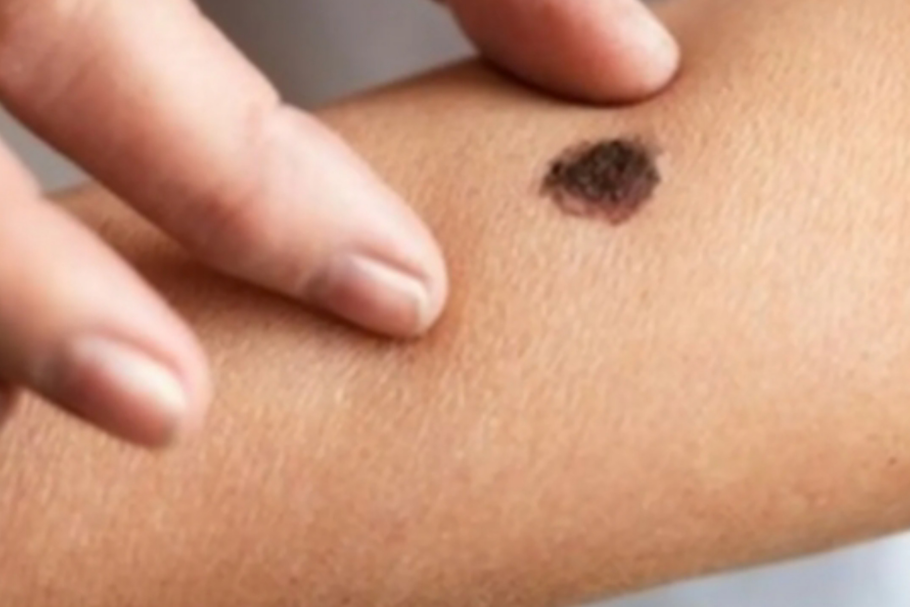 Rahasia Tahi Lalat Berambut: Kapan Anda Harus Waspada?